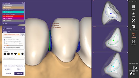 exocad_DentalCAD_Galway_Advanced_Bridge_Connectors