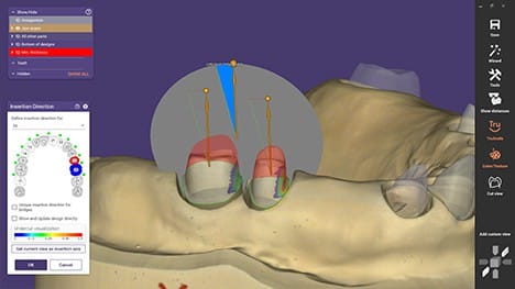 exocad_DentalCAD_Galway_Vastly_improved_Insertion